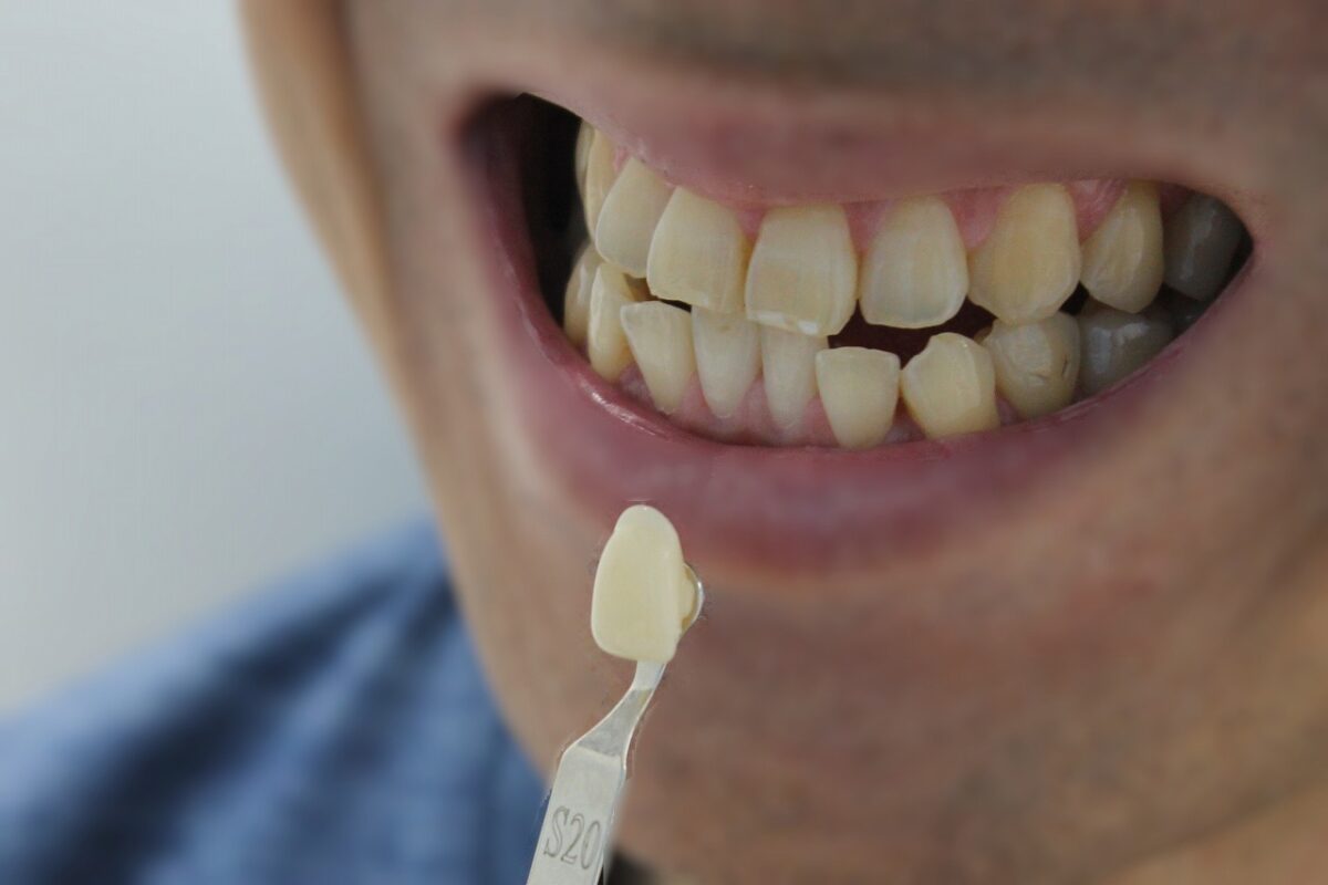 ホワイトニング施術前歯の白さチェック